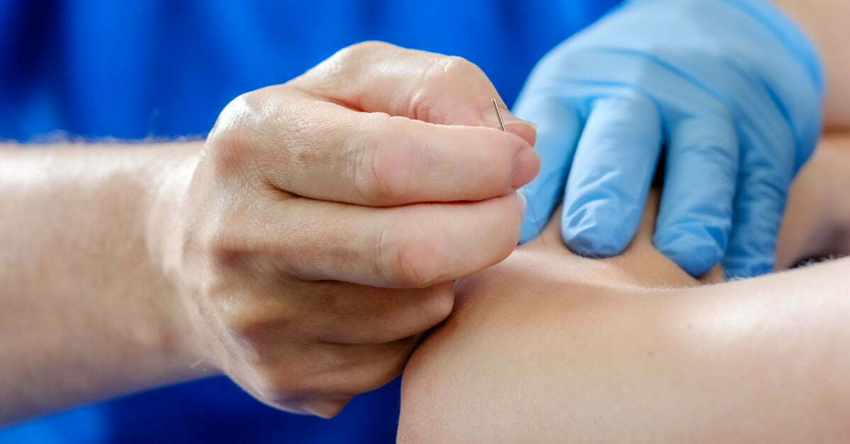 Dry Needling Roermond